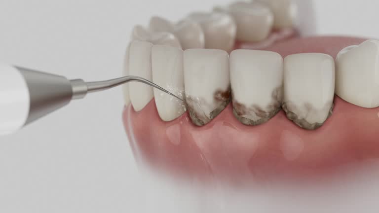 Trusted Tooth Extraction service in New Franklin, OH - Dentist Open Now